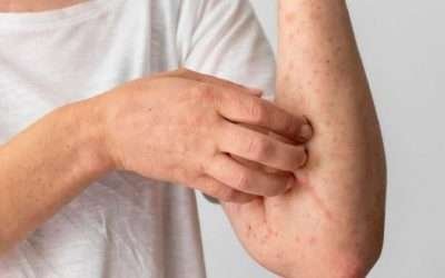 Confirman 1er caso de viruela símica en BC; fue detectado en Ensenada