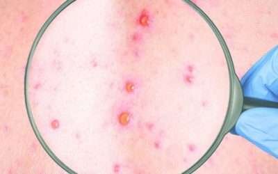 Hay tres nuevos casos de viruela simica en Baja California