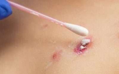 Descartan autoridades más casos de viruela símica en BC; dan de alta a paciente de Ensenada